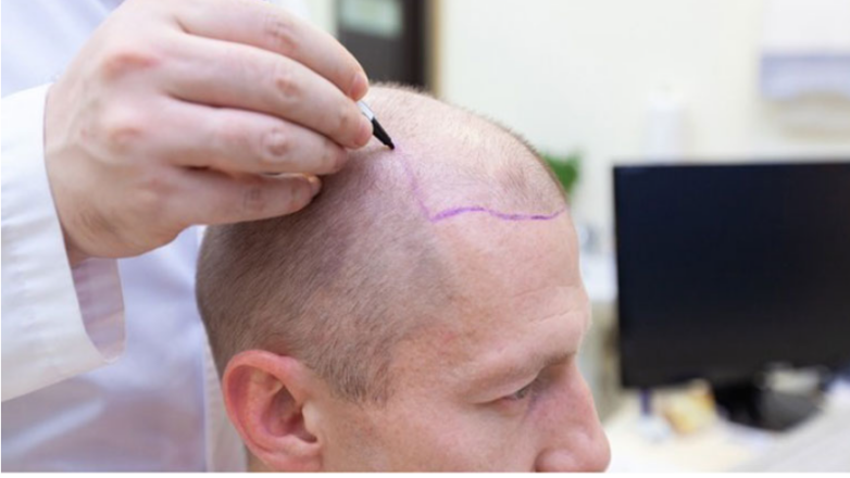 Μεταμόσχευση μαλλιών: Σύγχρονες έννοιες και τεχνικές