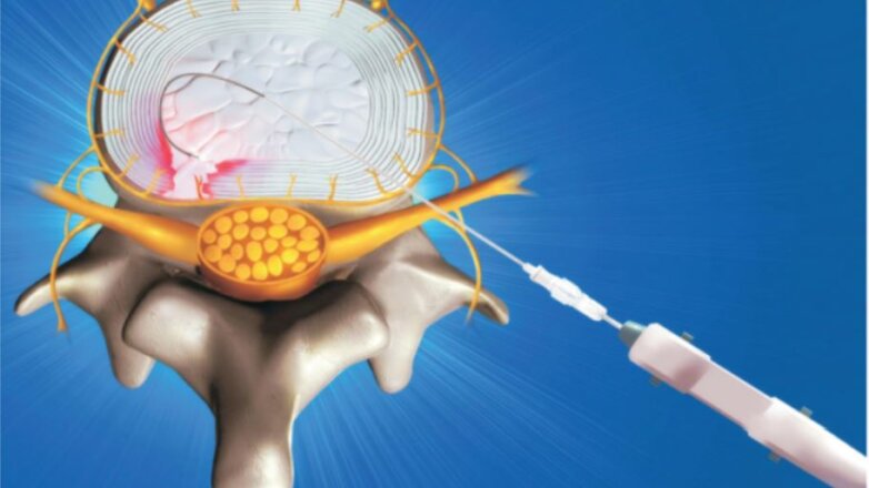 Η διαδερμική δισκοπλαστική στην αντιμετώπιση της οσφυϊκής κήλης του μεσοσπονδύλιου δίσκου