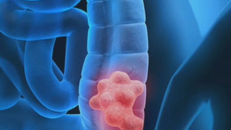 TAMIS: Η τεχνική διάσωσης του οργάνου στην αντιμετώπιση του καρκίνου του ορθού 