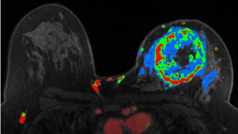 Μαγνητική τομογραφία μαστών: Τι πρέπει να ξέρετε