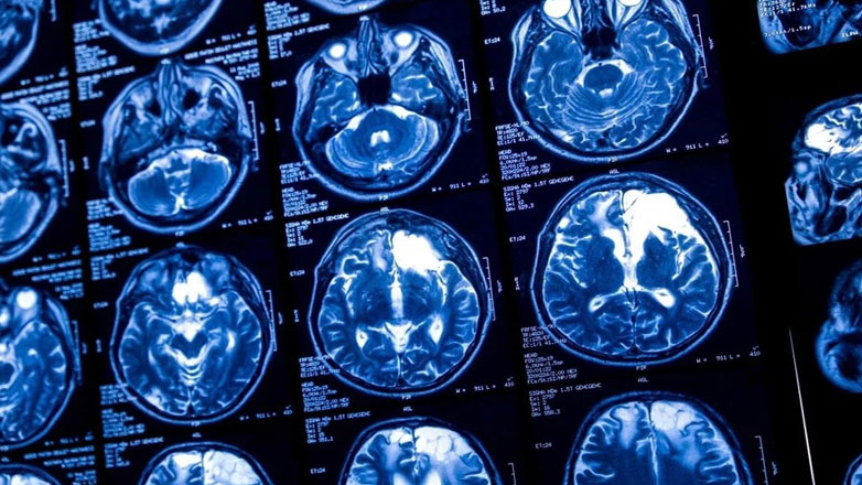 Άτομα με κατάθλιψη θα μπορούν να χρησιμοποιούν διακρανιακή εγκεφαλική διέγερση στο σπίτι, σύμφωνα με νέα μελέτη