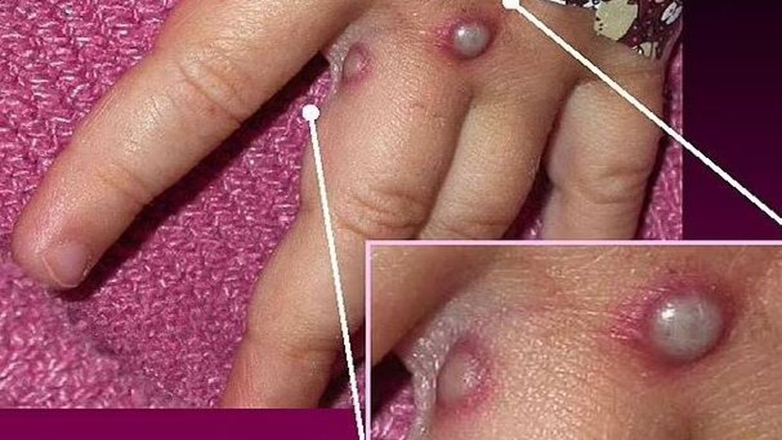 Βρετανία: Ανησυχία προκαλεί νέα παραλλαγή της ευλογιάς των πιθήκων