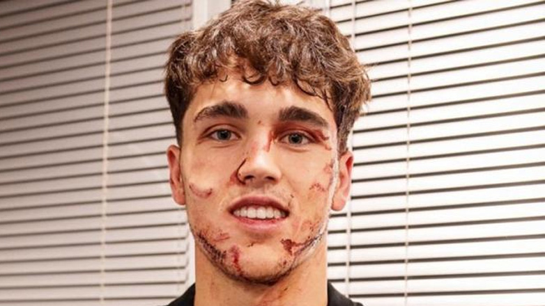 Μπαρτσελόνα: Σοκάρουν οι φωτογραφίες του Κουμπαρσί από την κλωτσιά που δέχθηκε στο πρόσωπο!