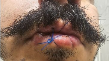 Ιράν: Ακτιβιστής έραψε τα χείλη του ως διαμαρτυρία για την αυτοκτονία συναγωνιστή του