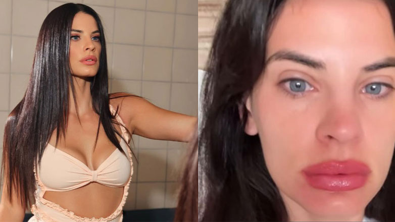 Χριστίνα Μπόμπα: «Ξύπνησα έτσι, τα χείλη μου έγιναν τριπλάσια»