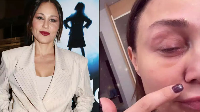 Με πρησμένο μάτι η Πηνελόπη Αναστασοπούλου – «Όποιος με καταράστηκε, συγχαρητήρια, τα κατάφερε»