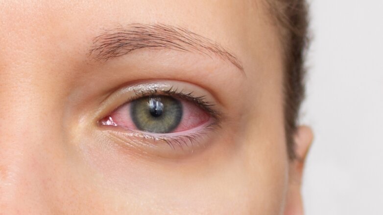 Παγκόσμια Ημέρα Sjögren: H διάγνωση καθυστερεί κατά μέσο όρο 5 χρόνια