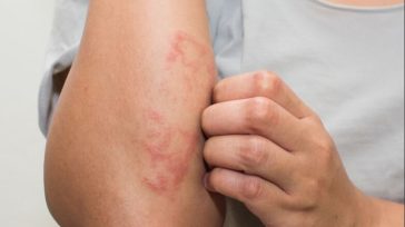 Τροφική αλλεργία: Ποια φρούτα πρέπει να προσέχετε το φθινόπωρο