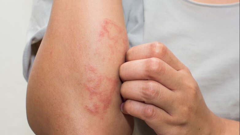 Τροφική αλλεργία: Ποια φρούτα πρέπει να προσέχετε το φθινόπωρο