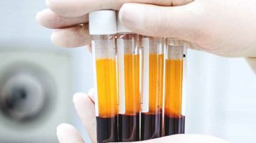 Πόσο Αποτελεσματική Είναι η Θεραπεία με PRP για τη Στυτική Δυσλειτουργία;