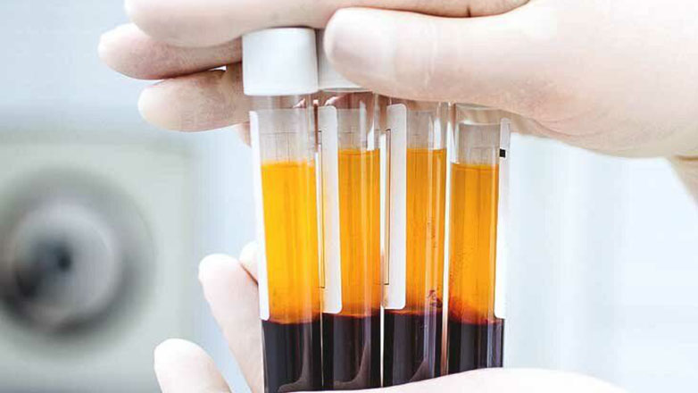 Πόσο Αποτελεσματική Είναι η Θεραπεία με PRP για τη Στυτική Δυσλειτουργία;