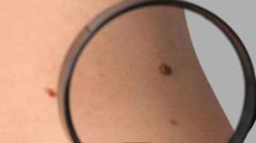 Μελάνωμα: Συνδυαστική θεραπεία μειώνει τον κίνδυνο υποτροπής ή θανάτου