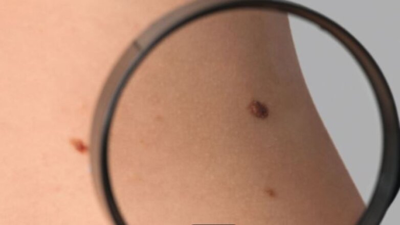 Σπίλοι: Πότε να μας ανησυχήσει μια ελιά στο δέρμα;