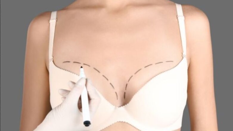 Αυξητική μαστών και ανόρθωση στο ίδιο χειρουργείο για φυσικό αποτέλεσμα