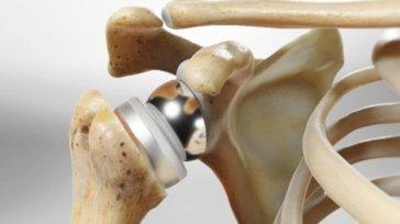 Ανάστροφη αρθροπλαστική ώμου: Σύγχρονη λύση για πολύπλοκα προβλήματα