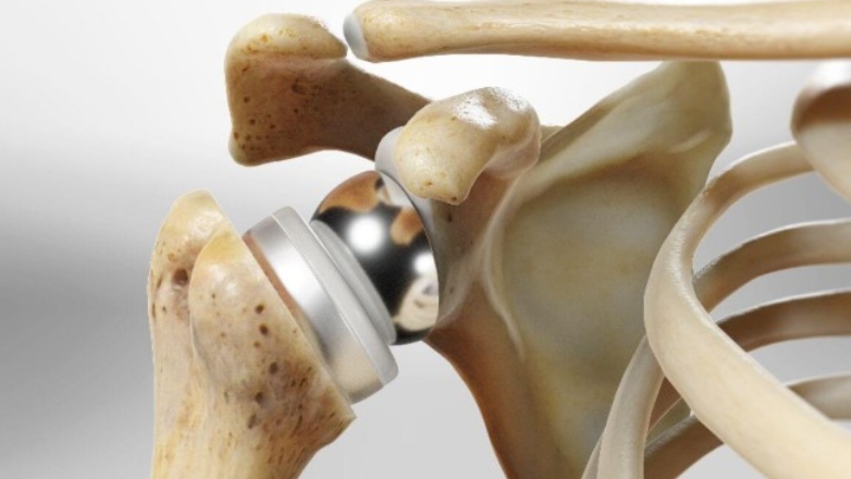 Ανάστροφη αρθροπλαστική ώμου: Σύγχρονη λύση για πολύπλοκα προβλήματα