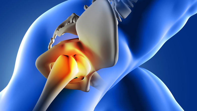 Ολική αρθροπλαστική ισχίου με τη μέθοδο ελάχιστης επεμβατικότητας ASI