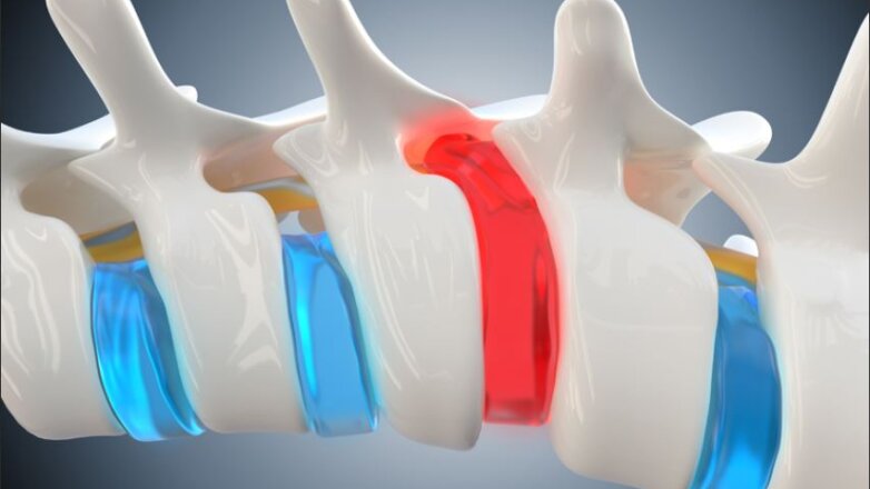 Κήλη μεσοσπονδύλιου δίσκου: Συμπτώματα και αντιμετώπιση