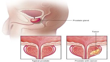 Καρκίνος Προστάτη, Ακράτεια και Στυτική Δυσλειτουργία