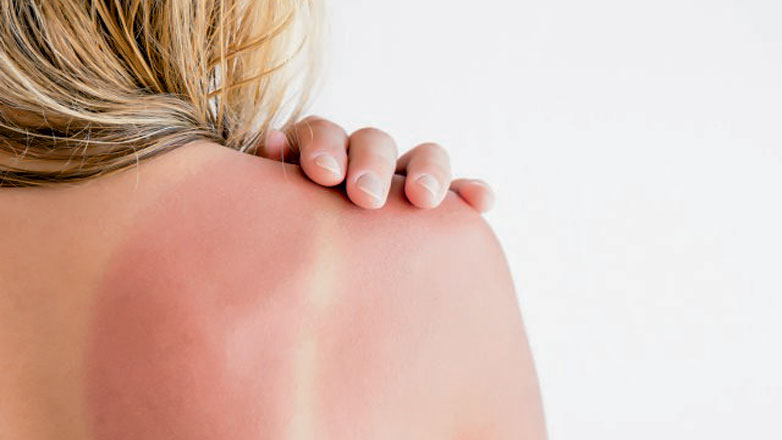 Αυξάνονται τα νέα περιστατικά καρκίνου του δέρματος