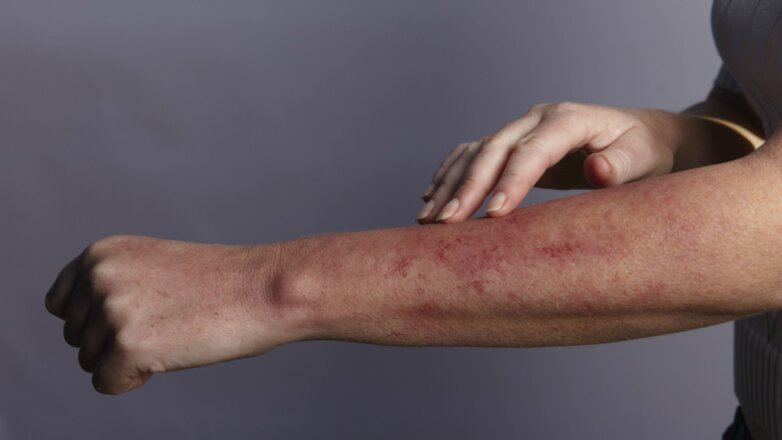 Τι πρέπει να γνωρίζετε για τον Συστηματικό Ερυθηματώδη Λύκο