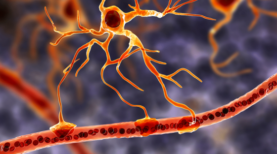 H σκλήρυνση κατά πλάκας σε απλή γλώσσα