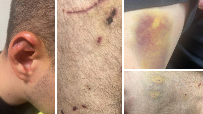 Φωτογραφίες ντοκουμέντα με τα σημάδια στο σώμα του 24χρονου από τα βασανιστήρια που του έκαναν οι απαγωγείς