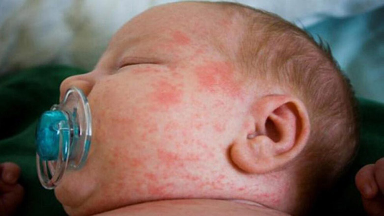 Σε έξαρση ο στρεπτόκοκκος στην Ευρώπη μετά την πανδημία