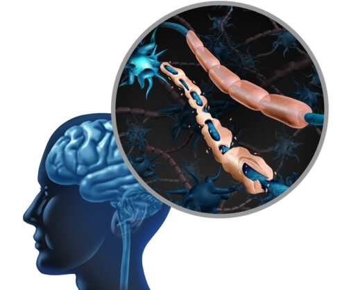 Εξελίξεις στη θεραπευτική αντιμετώπιση της Σκλήρυνσης κατά Πλάκας