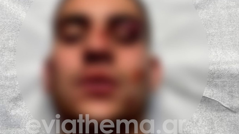 Χαλκίδα: 18χρονος έστειλε στο νοσοκομείο με κατάγματα 19χρονο για ένα like