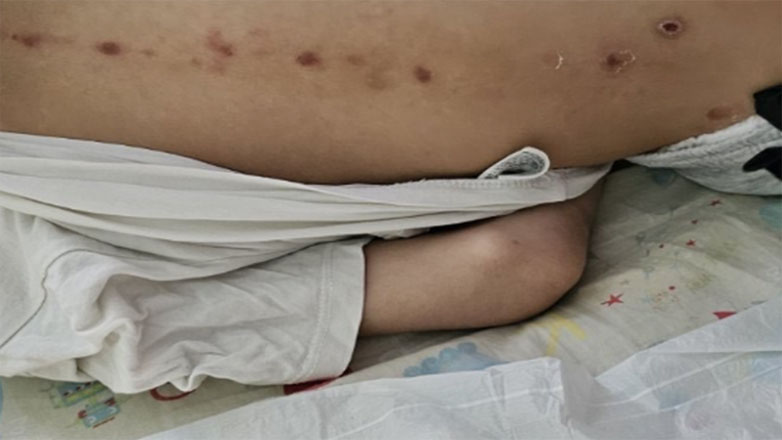 «Θρίλερ» με 7χρονο αγόρι που μεταφέρθηκε στο Καραμανδάνειο με σημάδια κακοποίησης