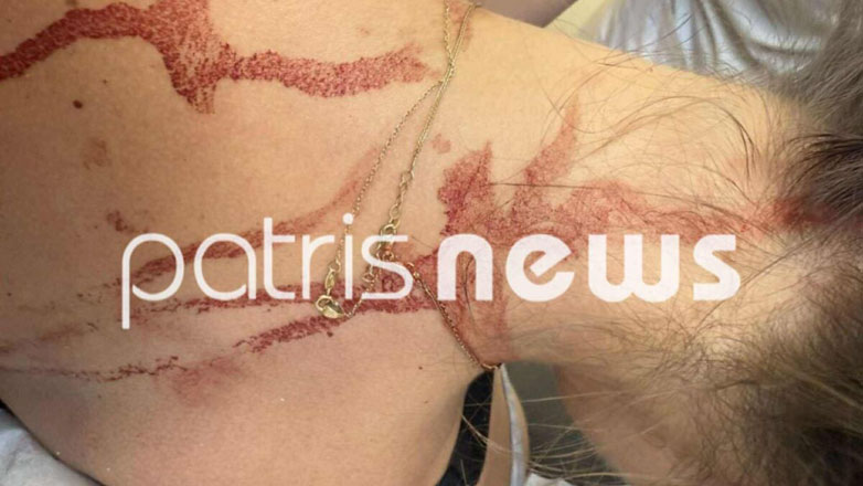 Την κάρφωσε με ψαλίδι στην πλάτη