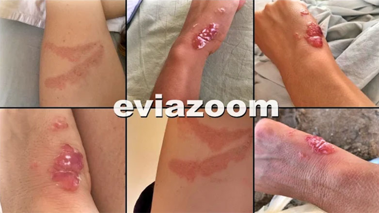 Εφιάλτης για δύο λουόμενες, που βγήκαν από τη θάλασσα με πληγές και σημάδια