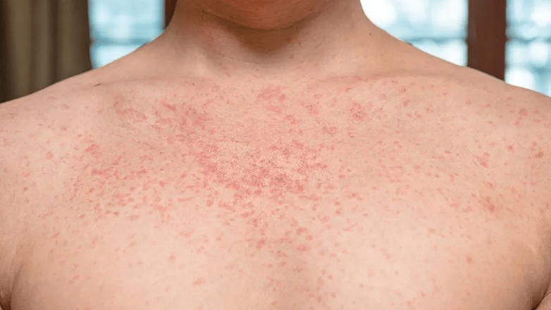 Δραματική αύξηση 65% της σύφιλης στην Ελλάδα κατά την πανδημία