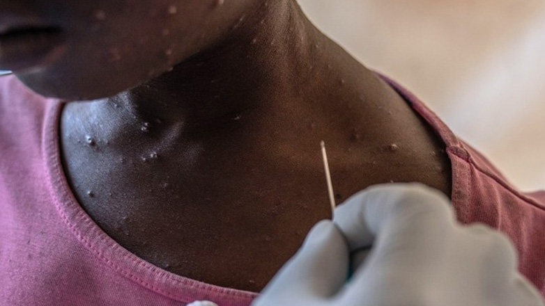 Γκάνα: Πρώτος θάνατος στη χώρα εξαιτίας της επιδημίας mpox