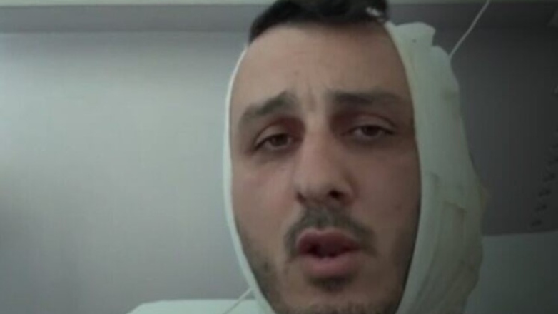 Σύρος δάγκωσε το αυτί Ισραηλινού τουρίστα στην παραλία Αλίμου