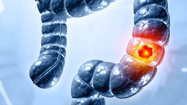 Καρκίνος του παχέος εντέρου: Ποια συμπτώματα προειδοποιούν;