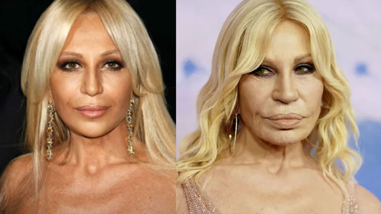 Αγνώριστη η Donatella Versace μετά τις πλαστικές επεμβάσεις!