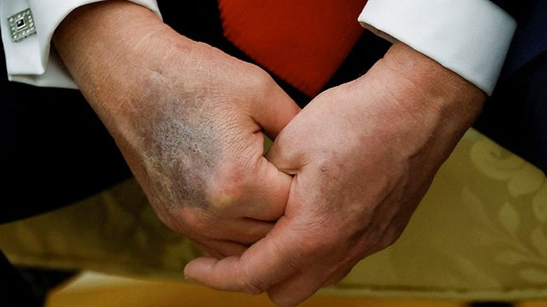 Ανησυχία για την υγεία του Ντόναλντ Τραμπ: Εμφανείς μώλωπες και ποικίλα σχόλια