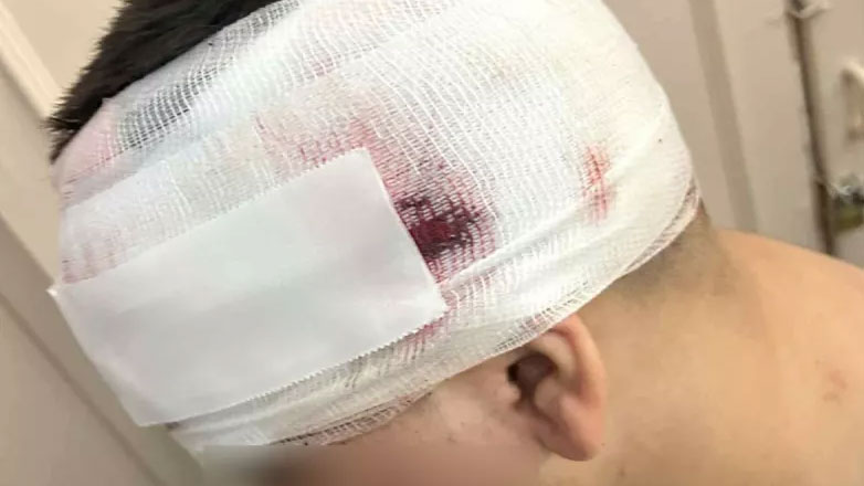 Σοκάρουν οι φωτογραφίες του 13χρονου που έπεσε θύμα άγριου ξυλοδαρμού από ομάδα νεαρών