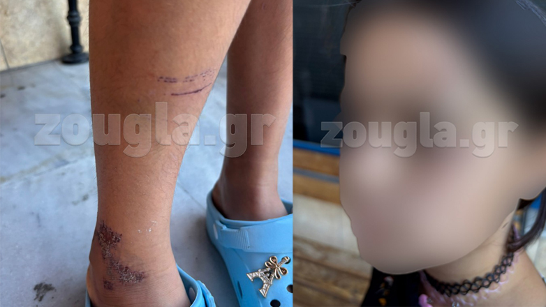 Νέες φωτογραφίες της 9χρονης που τραυματίστηκε σε τροχαίο στα Σεπόλια