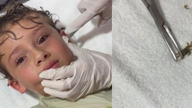 Βγάζουν από το αυτί παιδιού ένα… καβούρι