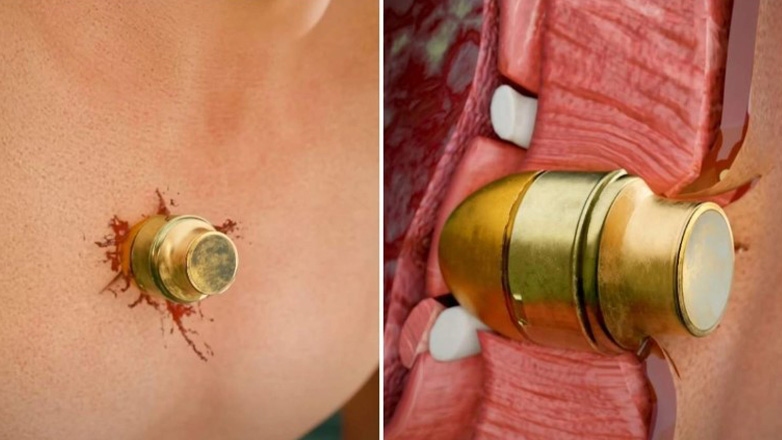 Στρατιώτης επέζησε με χειροβομβίδα στο στήθος του