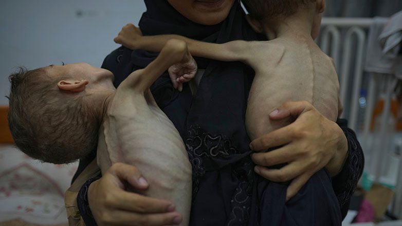 Μελέτη-σοκ για τη Γάζα: Ένα στα έξι παιδιά υφίσταται ακραίο οξύ υποσιτισμό Μελέτη-σοκ για τη Γάζα: Ένα στα έξι παιδιά υφίσταται ακραίο οξύ υποσιτισμό