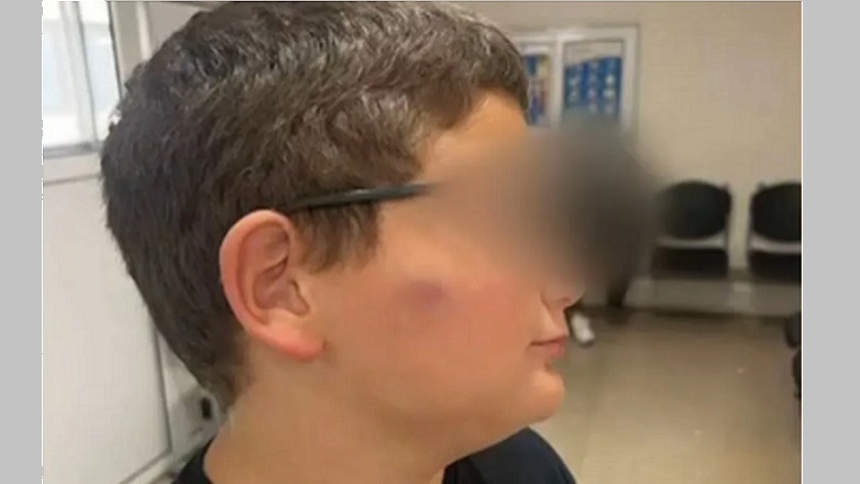 Θεσσαλονίκη: 11χρονος χτυπήθηκε από συμμαθητές του στο κεφάλι σε σχολείο