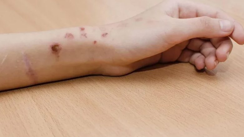 Ένα στα έξι παιδιά αυτοτραυματίζεται στη χώρα μας