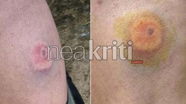 Ηράκλειο: Αγρότες στο νοσοκομείο με τραύματα από πλαστικές σφαίρες