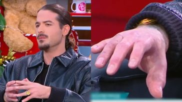 Άρης Μουγκοπέτρος: Η πρώτη δημόσια εμφάνιση με τα πρόσθετα δάχτυλα – «Δεν κρατάω κακία σε αυτόν τον άνθρωπο»