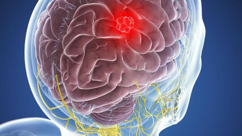 Από τη διάγνωση έως την ανάρρωση: Το «ταξίδι» μιας ασθενούς με μηνιγγίωμα