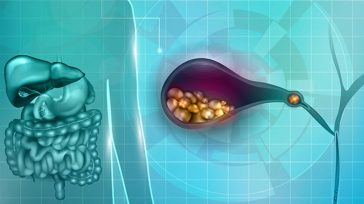 Χοληδόχος κύστη και πολύποδες: Διάγνωση και θεραπεία